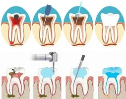 Benefits Of Root Canal Treatment For Oral Health