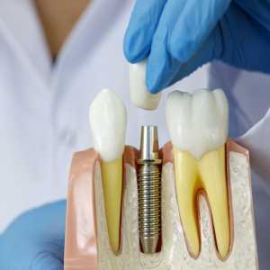 Common Myths About Dental Implants In Panchsheel Park Debunked Introduction