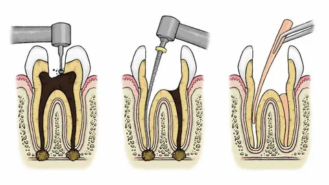 Emergency Root Canal: What To Do When You Need Immediate Treatment