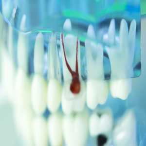 How To Choose The Perfect Dentist For Your Root Canal: A Comprehensive Guide