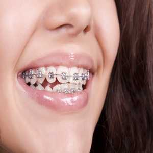 Straightening Things Out: The Ins And Outs Of Braces