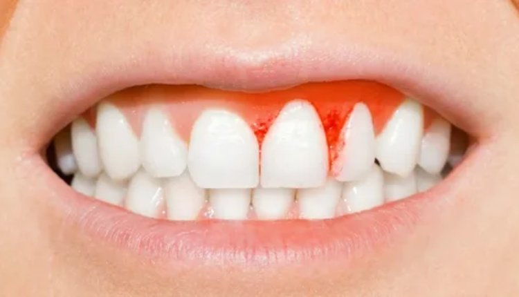 Addressing Bleeding Gum Treatment In Nizamabad: Restoring Oral Health And Comfort