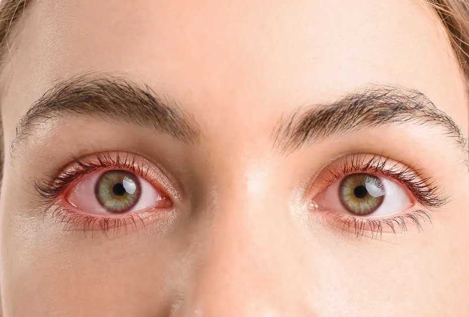 Dry Eye Syndrome And LASIK Surgery: What Chinchwad Ophthalmologists Check Before Proceeding