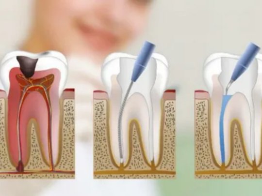 Everything You Need To Know About Root Canal Treatment In Nagpur