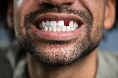 Fixed Teeth In A Day: How Same-Day Dental Implants Transform Your Smile
