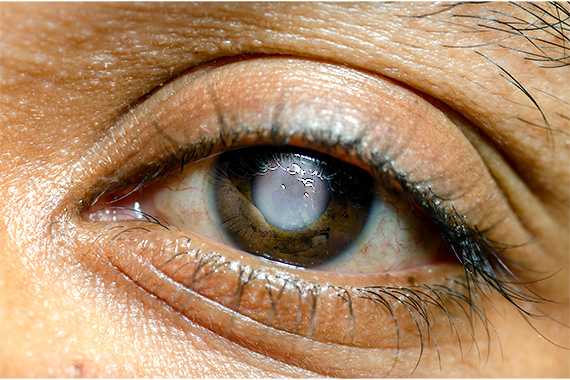 Glaucoma Treatment Explained: How Early Care Protects Your Vision