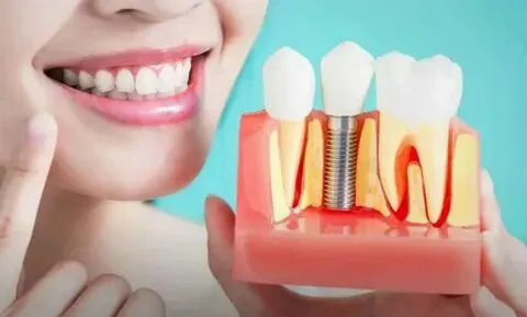 How Dental Implants Improve Oral Health And Boost Confidence