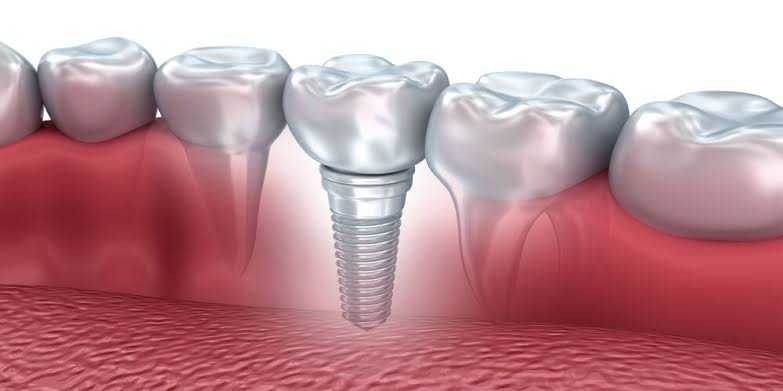 Missing Teeth? How Teeth Implants Can Restore Your Smile