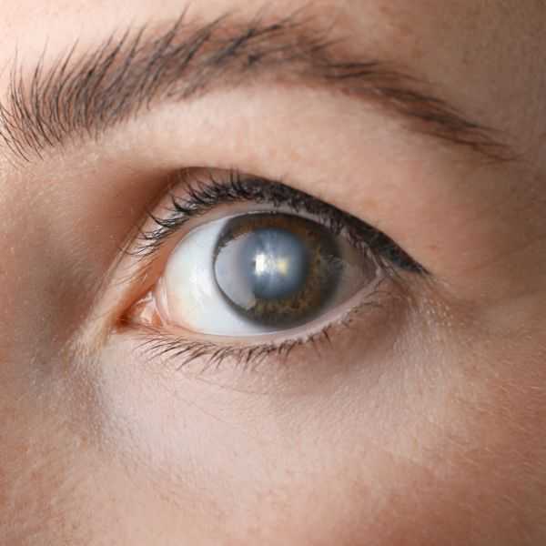 Motibindu Surgery: Everything You Need To Know Before Treatment