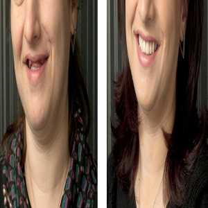 Can Smokers Get Fixed Teeth In A Day?