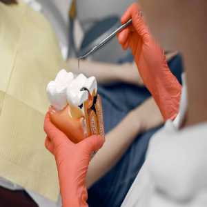 Common Myths About Root Canal Treatment You Should Stop Believing