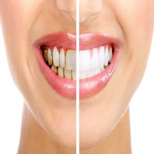 Dental Plaque: What Is It & How To Remove From Teeth