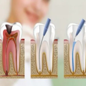 Everything You Need To Know About Root Canal Treatment In Nagpur