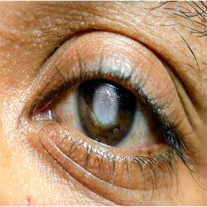 Glaucoma Treatment Explained: How Early Care Protects Your Vision