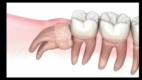 Impacted Wisdom Teeth: Causes, Symptoms, And Treatment Options