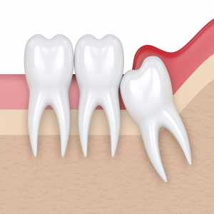 Is Tooth Extraction Safe For Diabetic Patients In Besa? A Complete Guide
