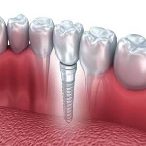 Missing Teeth? How Teeth Implants Can Restore Your Smile