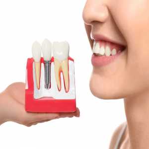 Same-Day Tooth Implants: Procedure, Recovery, And Results From A Fixed Teeth In Day In Besa Clinic