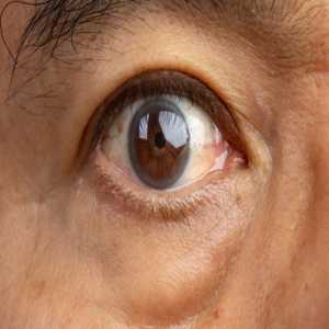 What Are The Signs Of Cataracts In Your Eyes?