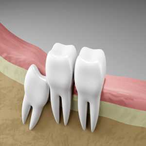 Wisdom Tooth Removal In Nadiad: What You Need To Know Before Your Appointment