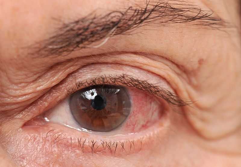 The Importance Of Early Detection In Glaucoma Management