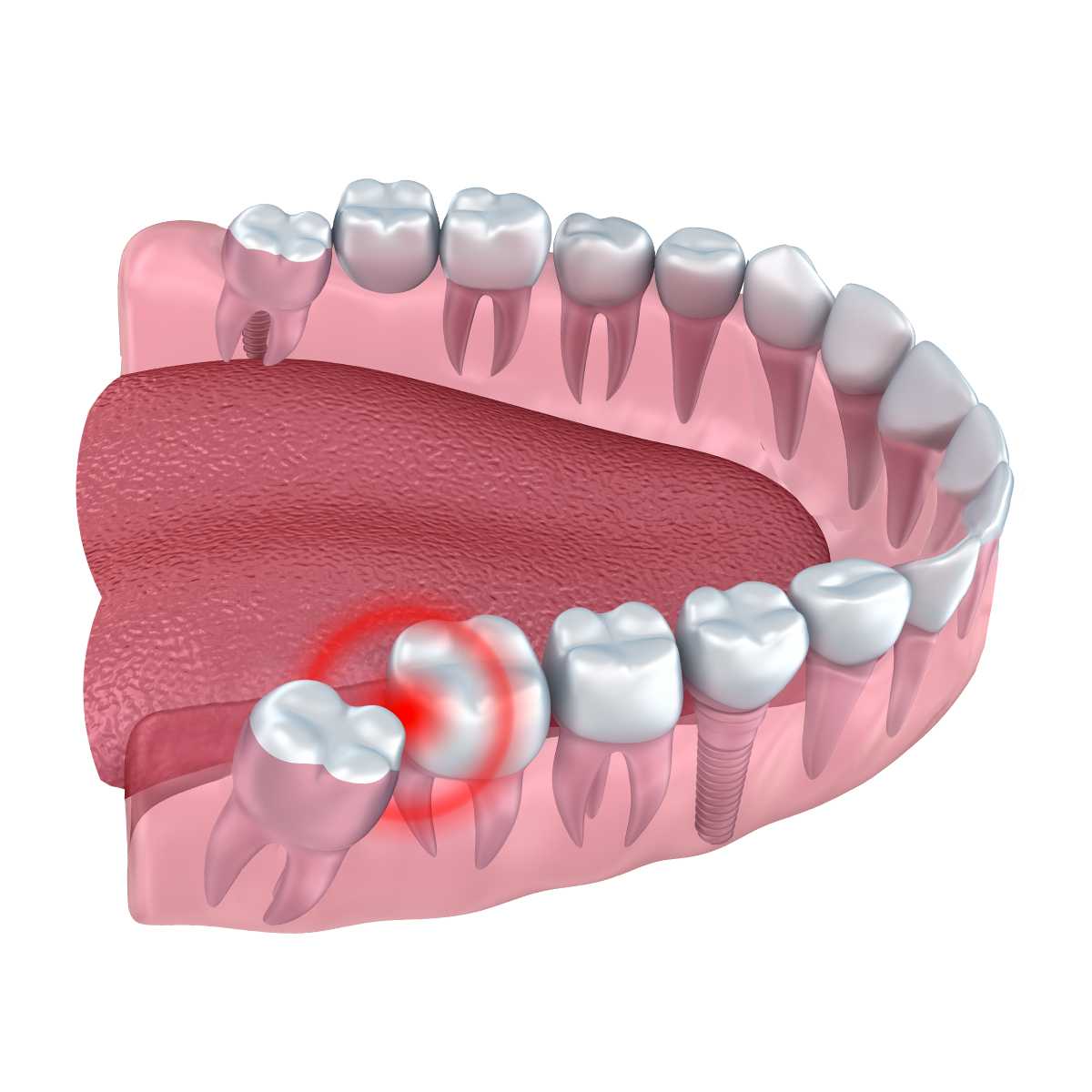 What To Expect During Wisdom Teeth Removal In Chula Vista