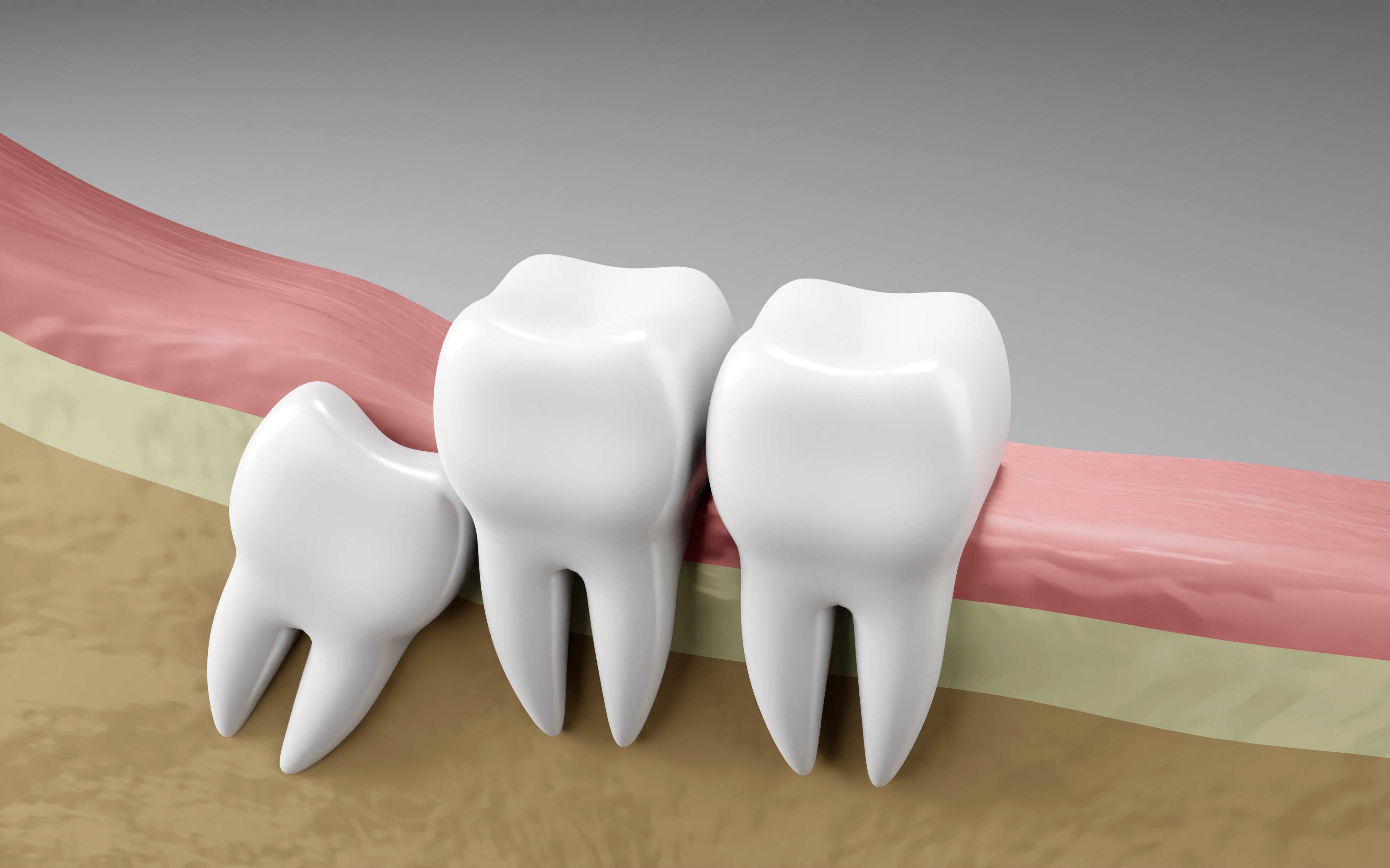 Wisdom Tooth Removal In Nadiad: What You Need To Know Before Your Appointment